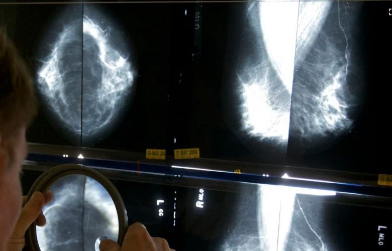 Ekspertët: Mamografia të fillojë në moshën 40 vjeçare