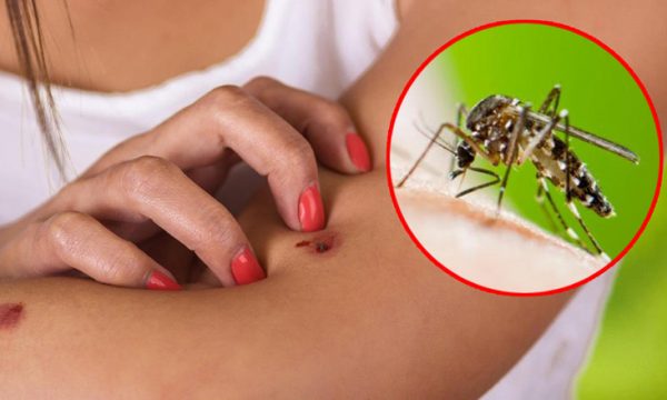 Si të mbroheni nga mushkonjat gjatë ditëve të nxehta?